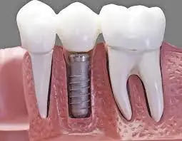 single tooth implant